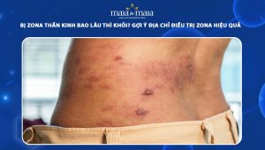 bị zona thần kinh bao lâu thì khỏi
