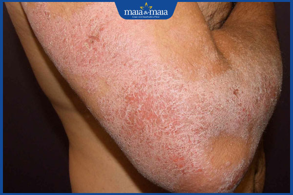 biến chứng của bệnh viêm da