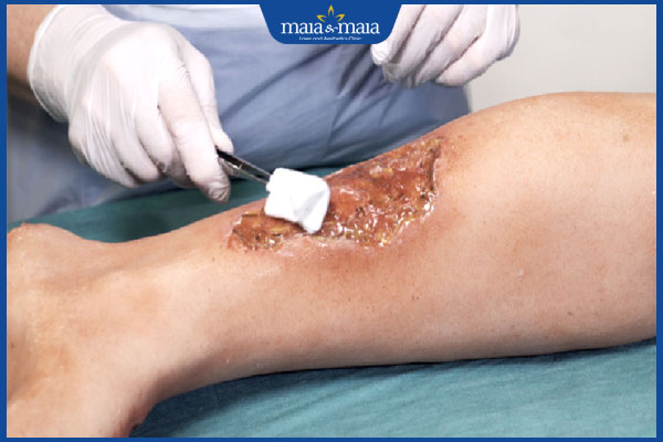 biến chứng viêm da mủ hoại thư