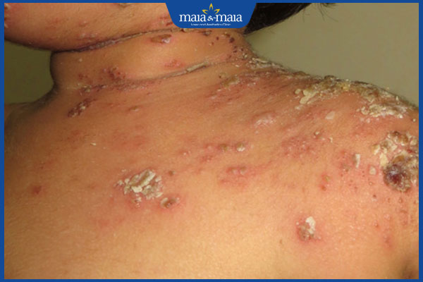 biến chứng viêm da tụ cầu ở trẻ