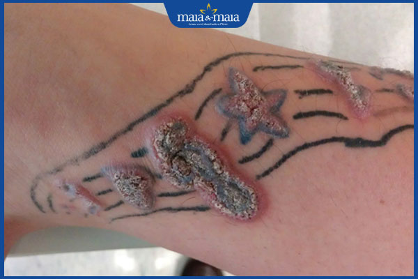 biến chứng xăm hình