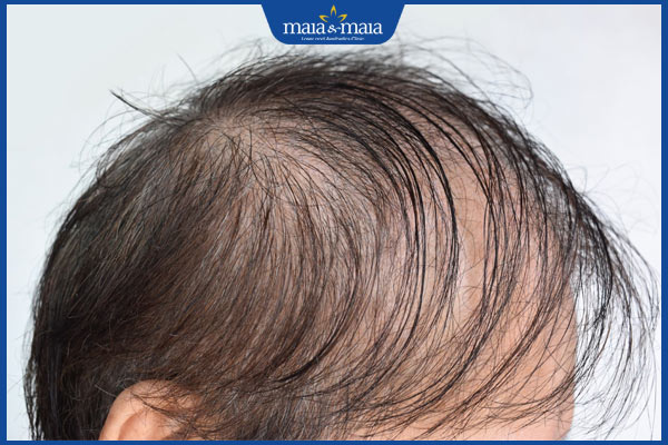 biểu hiện rụng tóc lan tỏa