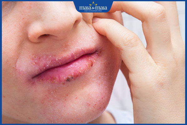 Viêm da cơ địa ở môi có nguy hiểm không? Điều trị thế nào? 2 biểu hiện viêm da cơ địa ở môi