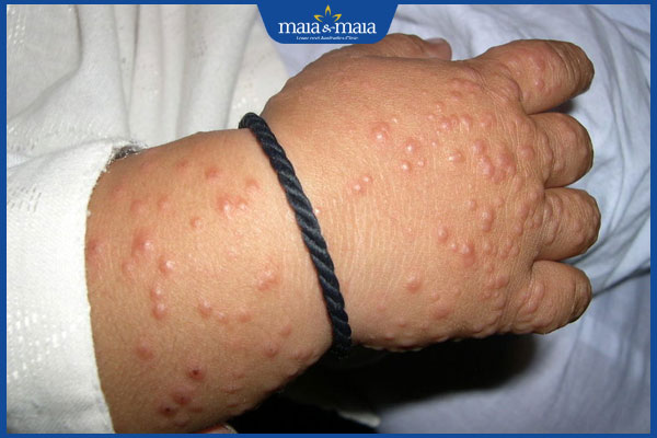 biểu hiện viêm da đầu chi dạng sẩn