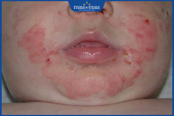 Viêm da đầu chi ruột là gì? Nguyên nhân và cách điều trị 2 biểu hiện Viêm da đầu chi ruột