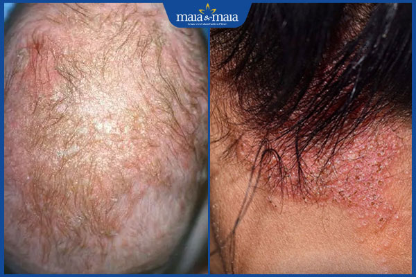 Viêm da dầu: Triệu chứng, chẩn đoán, điều trị và phòng ngừa 2 biểu hiện viêm da dầu
