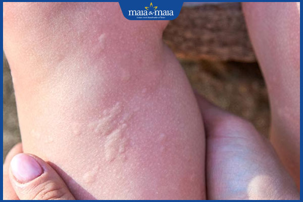 Viêm da dị ứng thời tiết có lây không? Điều trị như thế nào? 2 biểu hiện viêm da dị ứng thời tiết