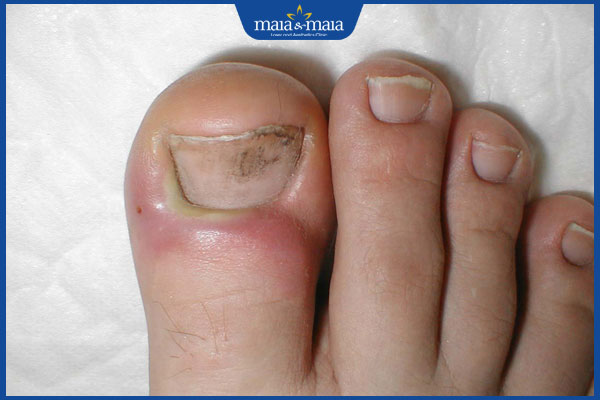 Viêm da quanh móng là gì? Nguyên nhân và hướng điều trị 2 biểu hiện viêm da móng