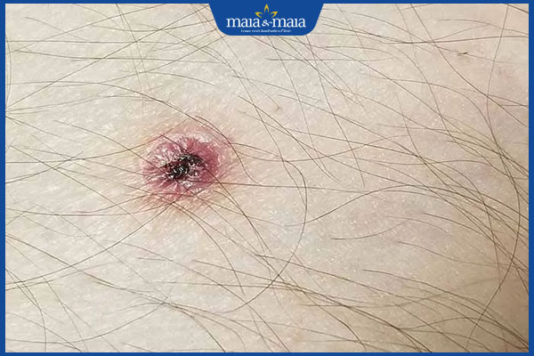 biểu hiện viêm da mủ