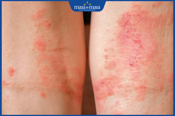 Viêm da tiếp xúc: Phân loại, chẩn đoán và cách điều trị 2 biểu hiện viêm da tiếp xúc