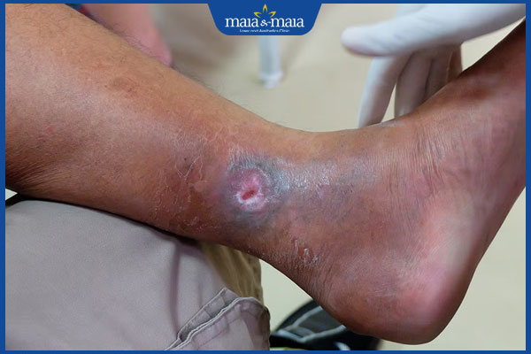 biểu hiện viêm da ứ đọng