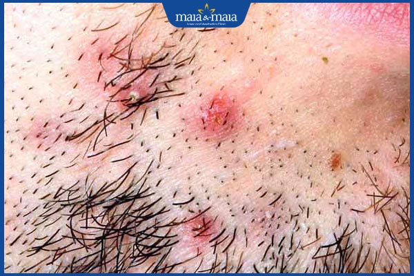 biểu hiện viêm nang lông râu