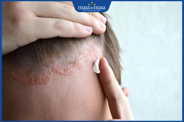 Mối liên hệ giữa viêm da tiết bã và rụng tóc 3 bôi kem tri viêm da dầu