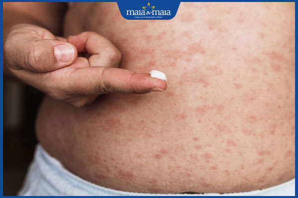 bôi thuốc cho vùng viêm da tiếp xúc