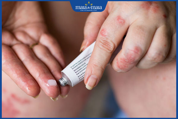 bôi thuốc chữa viêm da đầu chi