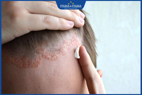 bôi thuốc trị viêm da tiết bã