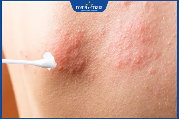 bôi thuốc trị zona