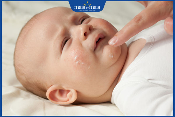 Chi tiết cách chăm sóc trẻ bị viêm da cơ địa tại nhà 5 bôi thuốc viêm da cơ địa cho trẻ