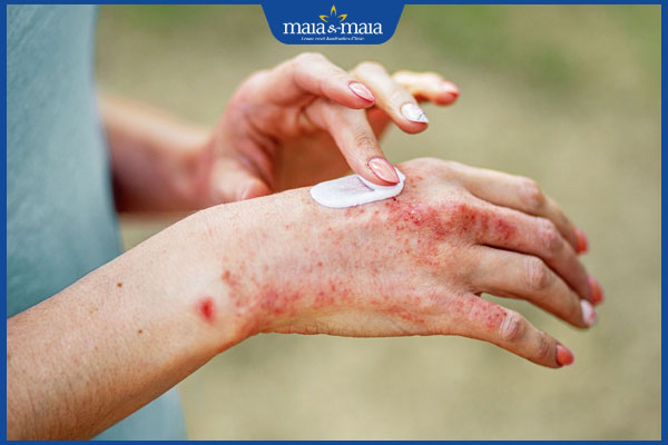 bôi thuốc viêm da tại chỗ