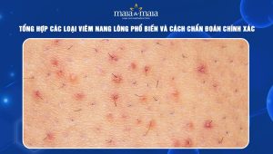 Các loại viêm nang lông