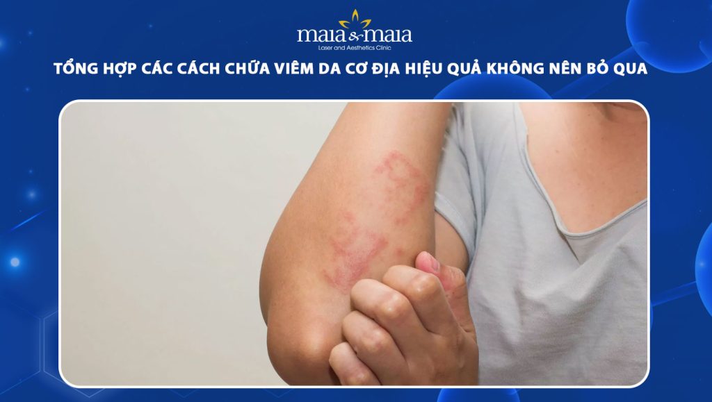 Tổng hợp các cách chữa viêm da cơ địa không nên bỏ qua 1 cách chữa viêm da cơ địa