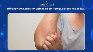 cách chữa viêm da cơ địa