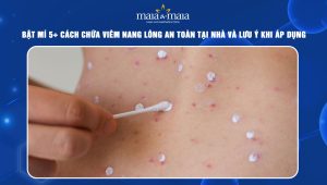 cách chữa viêm nang lông
