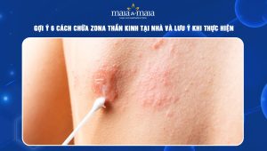 cách chữa zona thần kinh tại nhà