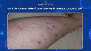 cách trị viêm lỗ chân lông ở bắp chân