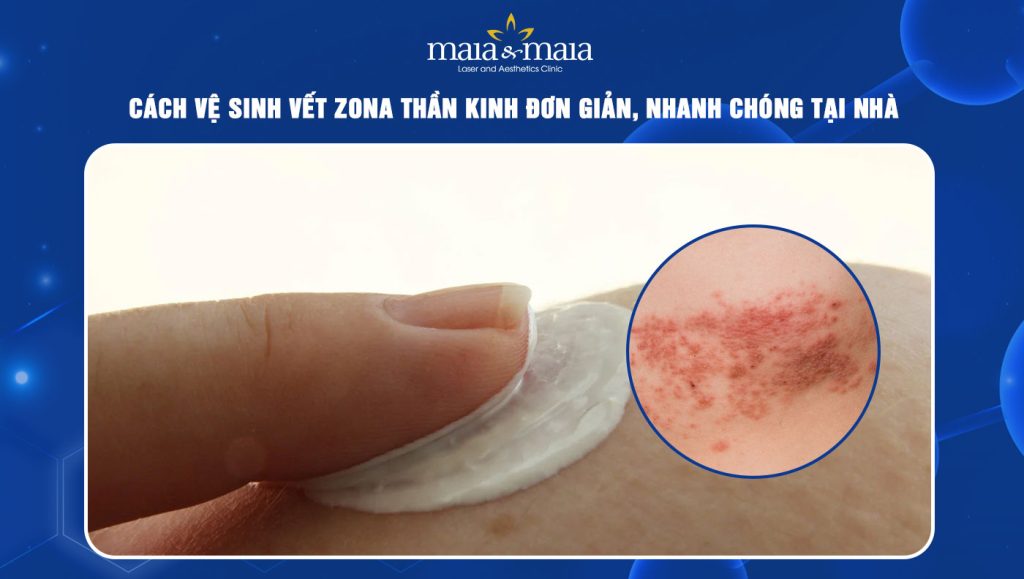 cách vệ sinh vết zona thần kinh