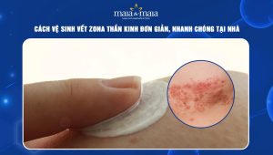 cách vệ sinh vết zona thần kinh