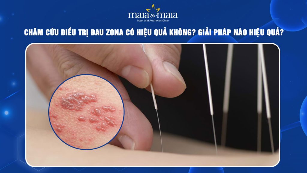 Châm cứu điều trị đau zona