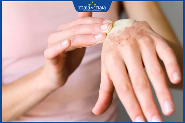 Tổng hợp danh sách 11 loại lá cây chữa viêm da dị ứng 8 chăm sóc da bị viêm da dị ứng