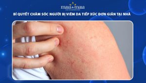 chăm sóc người bị viêm da tiếp xúc