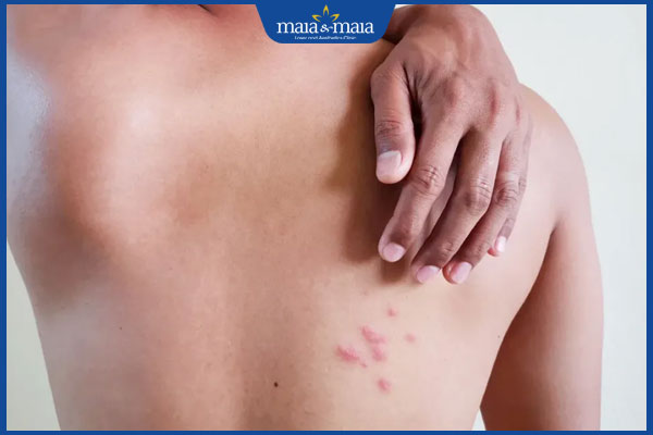 Zona thần kinh liên sườn: Nguyên nhân và hướng điều trị 3 chạm vào vùng zona