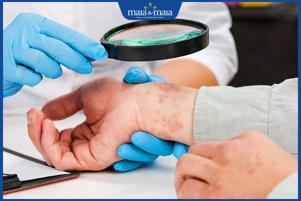 chẩn đoán bệnh viêm da