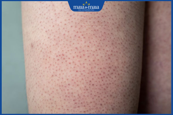 Viêm lỗ chân lông ở chân do đâu? Cách điều trị và phòng ngừa 2 chân viêm nang lông