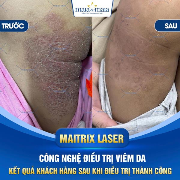 chữa viêm da cơ địa thành công