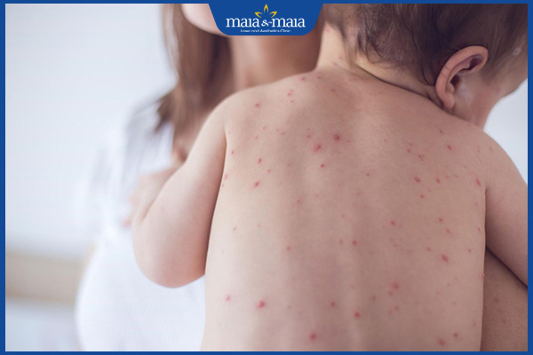 Nhiễm trùng da ở trẻ sơ sinh: Nguyên nhân và cách điều trị 3 da bị nhiễm trùng do virus ở trẻ nhỏ