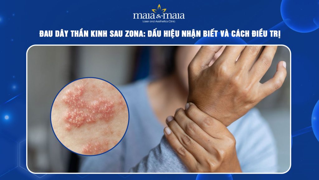 đau dây thần kinh sau zona
