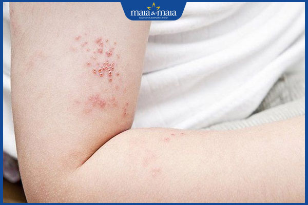 Dấu hiệu bệnh zona sắp khỏi và cách phòng ngừa bệnh tái phát 5 dấu hiệu bệnh zona đang khỏi