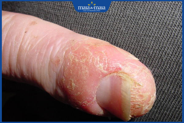 dấu hiệu nhận biết viêm da đầu chi