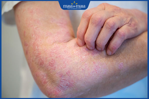 Viêm da dị ứng kinh niên là gì? Cách điều trị như thế nào? 2 dấu hiệu viêm da dị ứng kinh niên