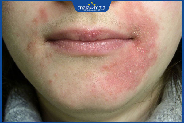 Viêm da dị ứng ở mặt có nguy hiểm không? Cách điều trị 2 dấu hiệu viêm da dị ứng