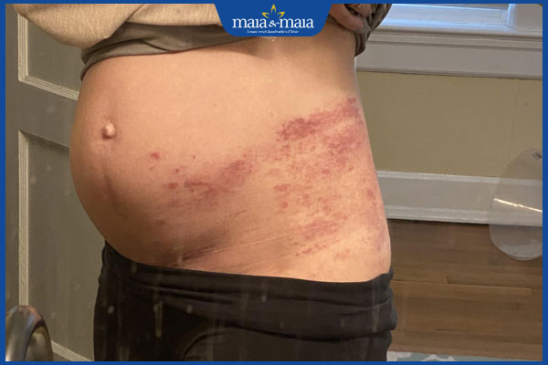 dấu hiệu zona thần kinh ở bà bầu