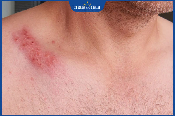 đau thần kinh sau zona