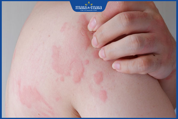 Viêm da dị ứng ở trẻ em: Dấu hiệu nhận biết và cách điều trị 5 dị ứng ở trẻ gây ngứa