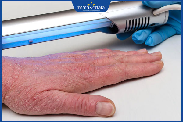 Tổng hợp các cách chữa viêm da cơ địa không nên bỏ qua 4 dùng liệu pháp ánh sáng chữa viêm da cơ địa