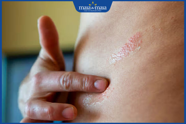 Hướng dẫn cách dùng hồ nước trị viêm da cơ địa tại nhà 3 dưỡng ẩm cho da viêm da cơ địa