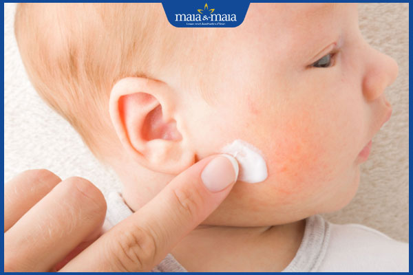 dưỡng ẩm cho trẻ bị viêm da